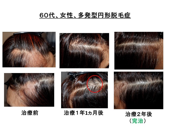 円形脱毛症　病院